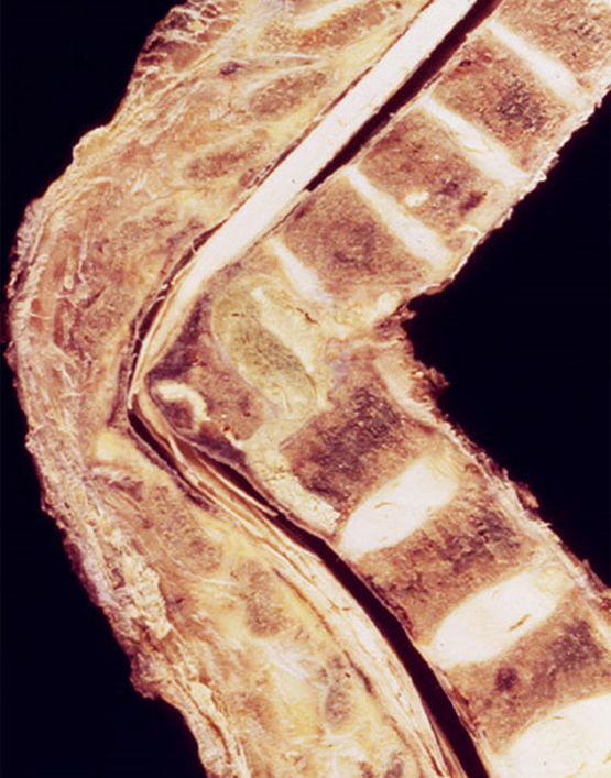 Pathology Outlines Tuberculous Osteomyelitis